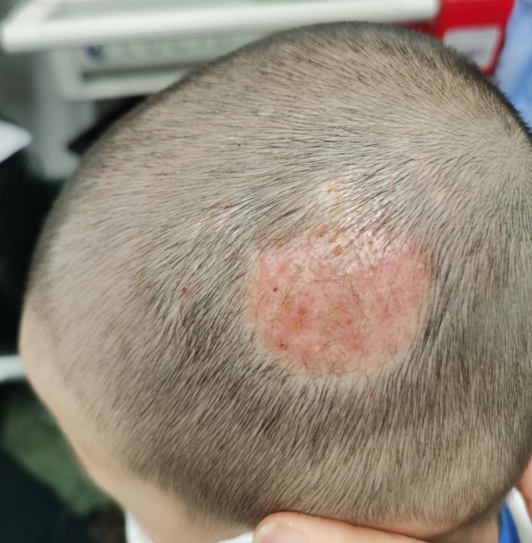 头癣发作又痒又红又肿，别怕，中医有办法！